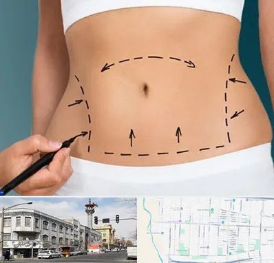 عمل ابدومینوپلاستی در 17شهریور