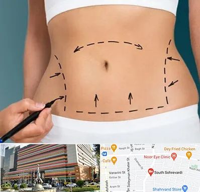 عمل ابدومینوپلاستی در سهروردی