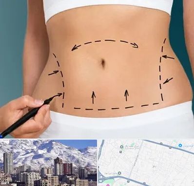 عمل ابدومینوپلاستی در ازگل