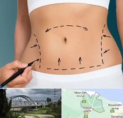 عمل ابدومینوپلاستی در چالوس