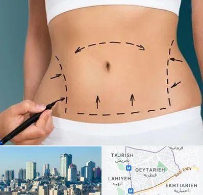 عمل ابدومینوپلاستی در قیطریه