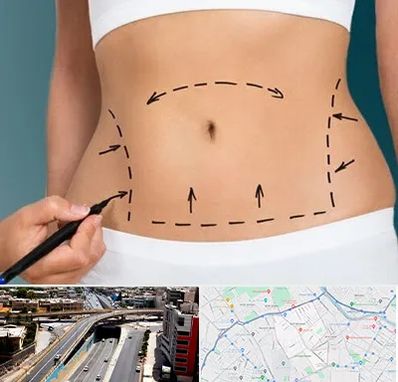 عمل ابدومینوپلاستی در ستارخان شیراز