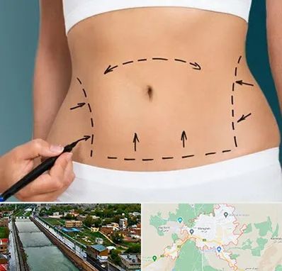 عمل ابدومینوپلاستی در مراغه