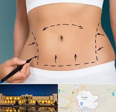 عمل ابدومینوپلاستی در برازجان