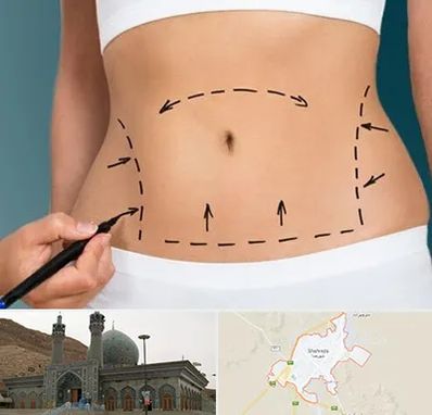 عمل ابدومینوپلاستی در شهرضا