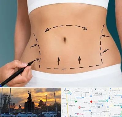 عمل ابدومینوپلاستی در میدان حر