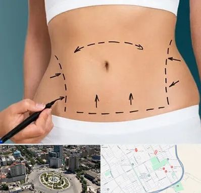 عمل ابدومینوپلاستی در زرافشان اسلامشهر