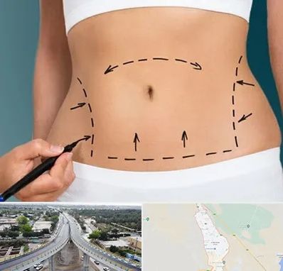 عمل ابدومینوپلاستی در اندیمشک