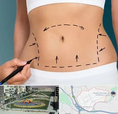 عمل ابدومینوپلاستی در مرزداران تبریز