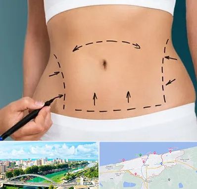 عمل ابدومینوپلاستی در بابلسر