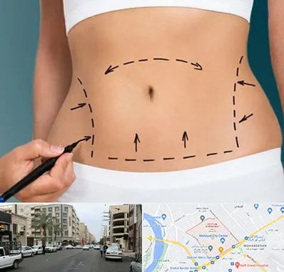 عمل ابدومینوپلاستی در زیتون کارمندی اهواز