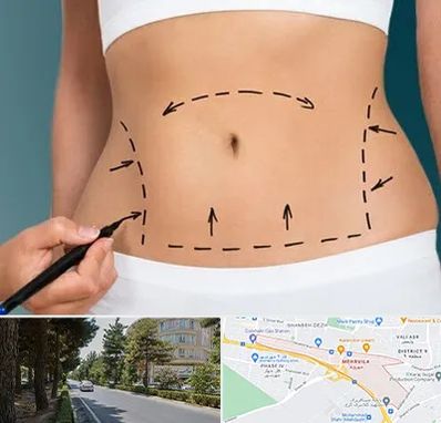 عمل ابدومینوپلاستی در مهرویلا کرج