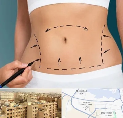 عمل ابدومینوپلاستی در جنوب غرب تهران