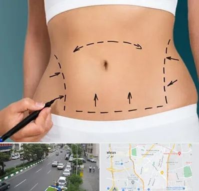 عمل ابدومینوپلاستی در ستارخان