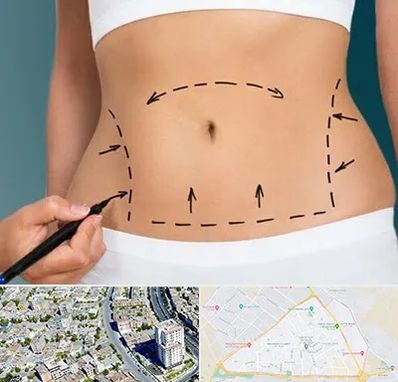 عمل ابدومینوپلاستی در قاسم آباد مشهد