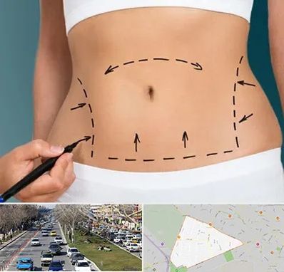 عمل ابدومینوپلاستی در احمدآباد مشهد