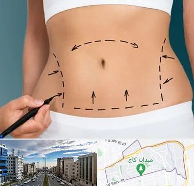 عمل ابدومینوپلاستی در سعادت آباد تهران