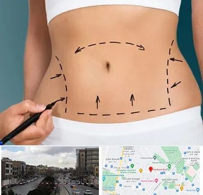 عمل ابدومینوپلاستی در بلوار فردوسی مشهد