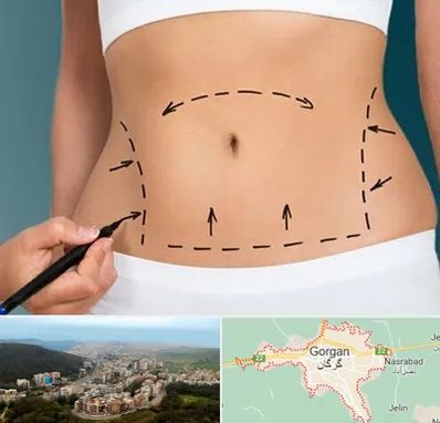 عمل ابدومینوپلاستی در گرگان