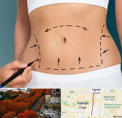 عمل ابدومینوپلاستی در ولیعصر