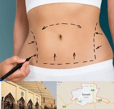 عمل ابدومینوپلاستی در ساوه