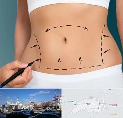 عمل ابدومینوپلاستی در ماهدشت کرج