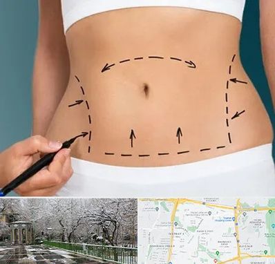 عمل ابدومینوپلاستی در باغ فیض