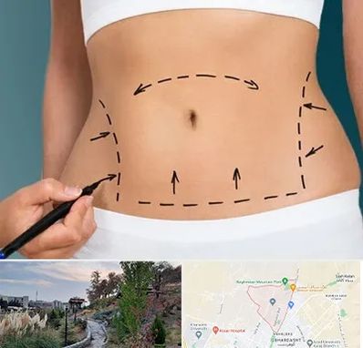 عمل ابدومینوپلاستی در باغستان کرج