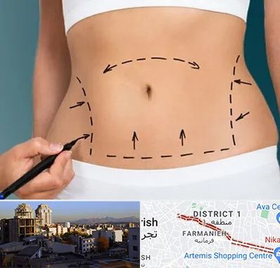 عمل ابدومینوپلاستی در فرمانیه