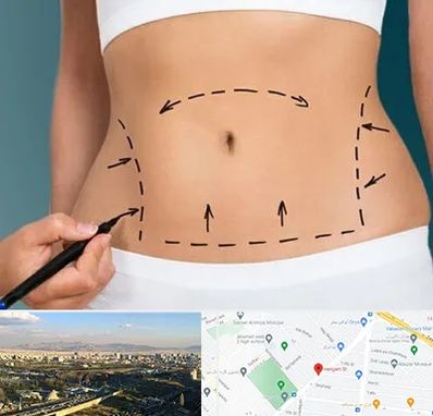 عمل ابدومینوپلاستی در هنگام