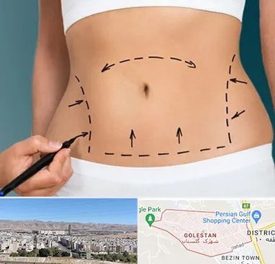 عمل ابدومینوپلاستی در شهرک گلستان شیراز