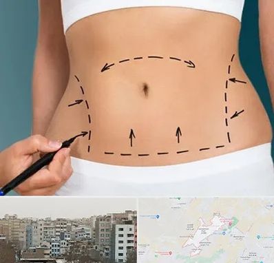 عمل ابدومینوپلاستی در محمد شهر کرج