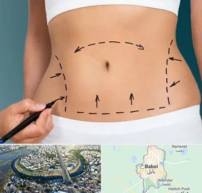 عمل ابدومینوپلاستی در بابل