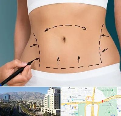 عمل ابدومینوپلاستی در حقانی