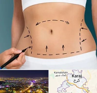 عمل ابدومینوپلاستی در کرج