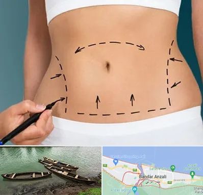 عمل ابدومینوپلاستی در بندر انزلی