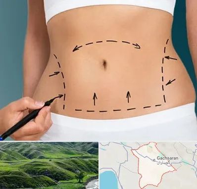 عمل ابدومینوپلاستی در گچساران