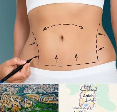 عمل ابدومینوپلاستی در اردبیل