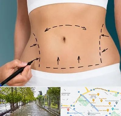 عمل ابدومینوپلاستی در خیابان ارم شیراز