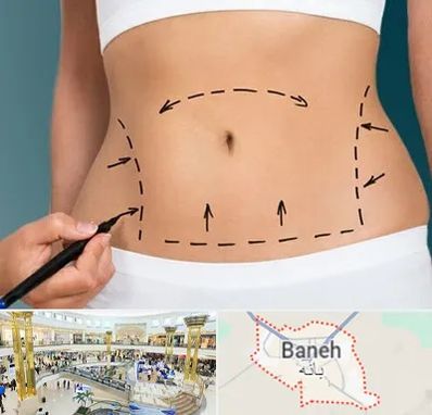عمل ابدومینوپلاستی در بانه