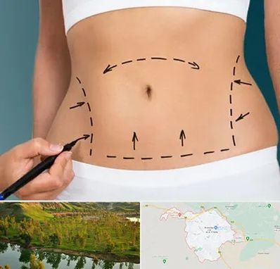 عمل ابدومینوپلاستی در بهبهان