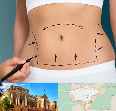 عمل ابدومینوپلاستی در خوی