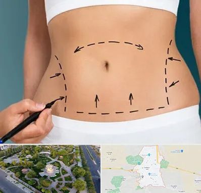 عمل ابدومینوپلاستی در کاشمر