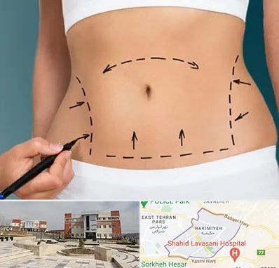 عمل ابدومینوپلاستی در حکیمیه