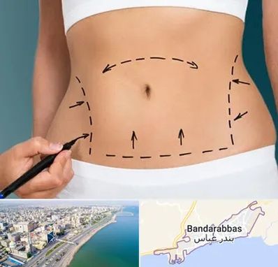عمل ابدومینوپلاستی در بندرعباس