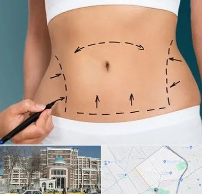 عمل ابدومینوپلاستی در طلاب مشهد