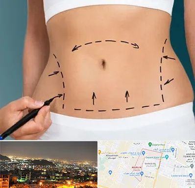 عمل ابدومینوپلاستی در مارلیک کرج
