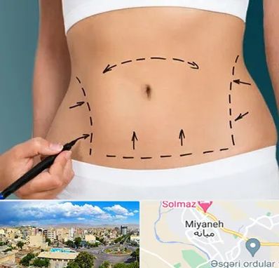 عمل ابدومینوپلاستی در میانه