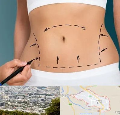 عمل ابدومینوپلاستی در یاسوج