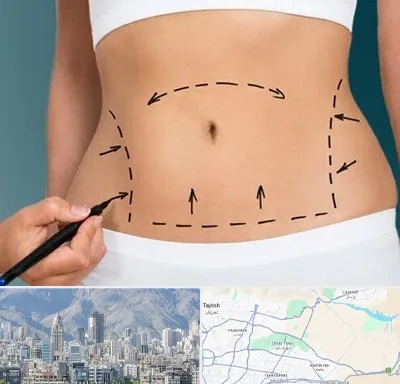 عمل ابدومینوپلاستی در شمال شرق تهران